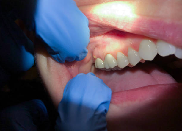 Best Teeth Whitening  in Cheyenne, WY