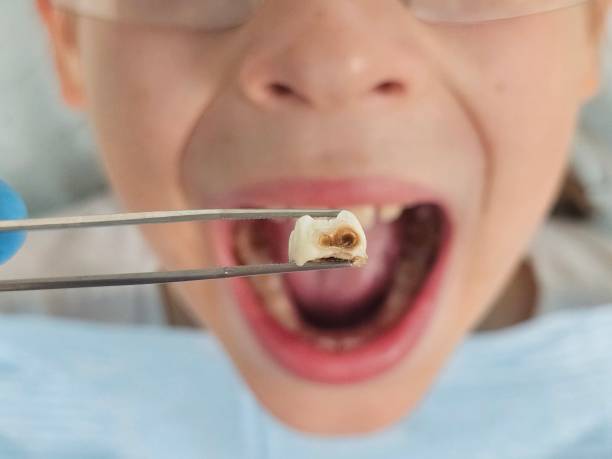 Best Emergency Dental Filling Replacement  in Cheyenne, WY