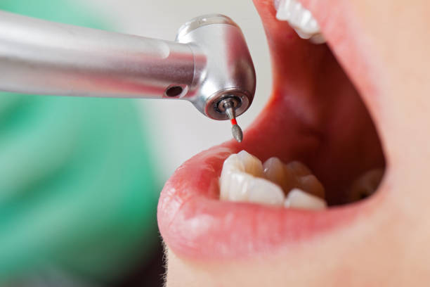 Best Chipped Tooth Repair Near Me  in Cheyenne, WY